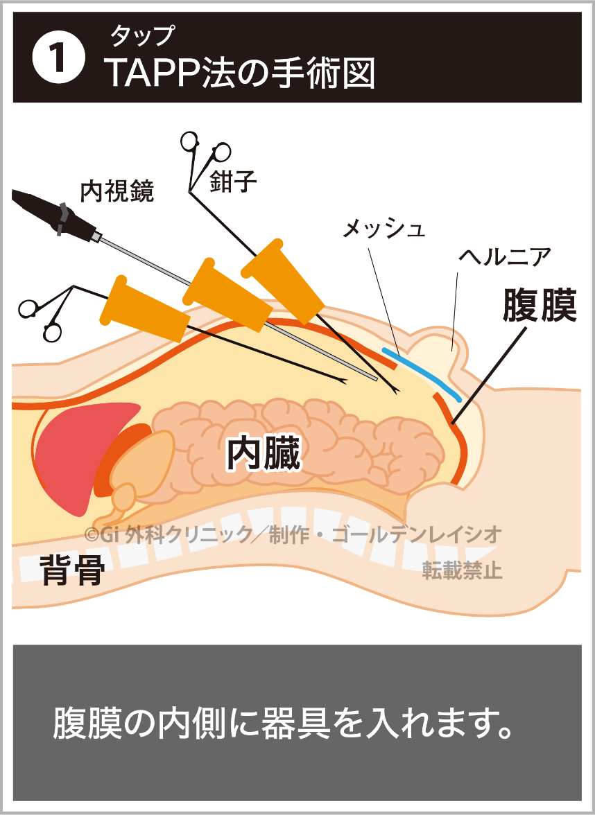 ①TAPP（タップ）法の手術図。腹膜の内側に器具を入れます。